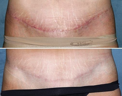 pictures and stages of wound healing after a tummy tuck