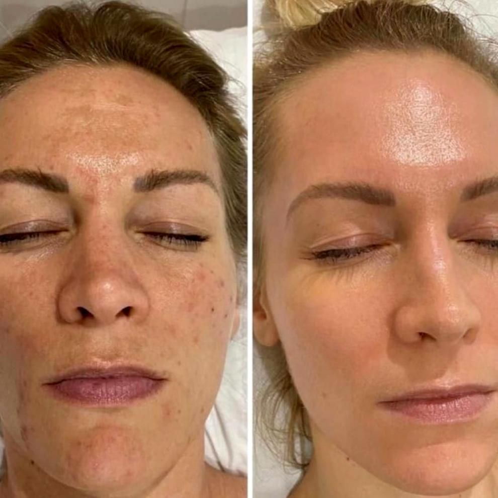 before and after pictures of a chemical peel