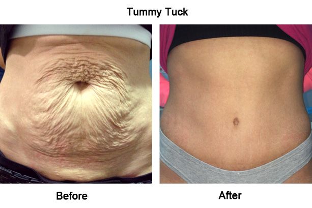 before and after pictures of a tummy tuck