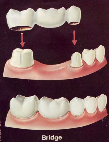 picture of a dental bridge