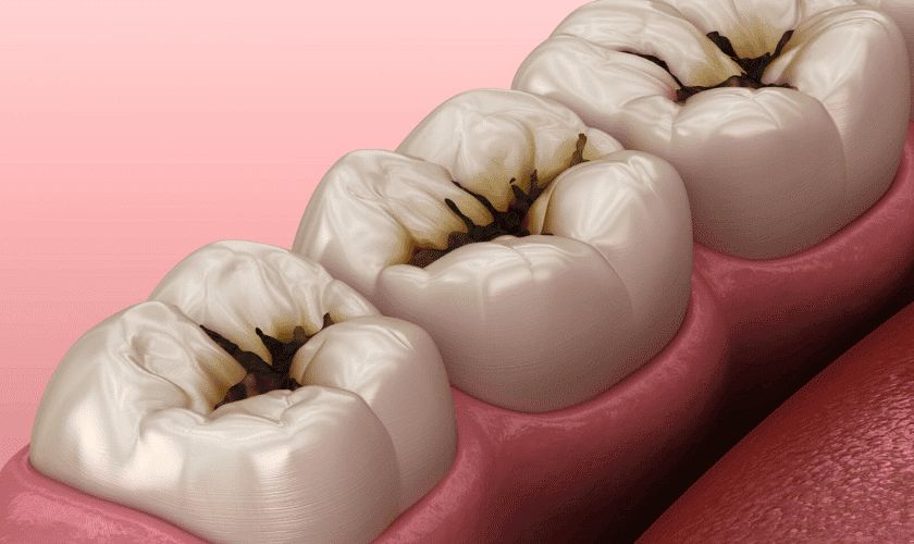 picture of a cavity in a tooth