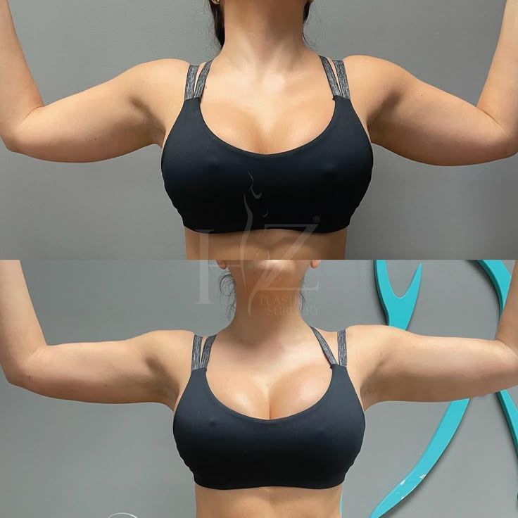 before and after pictures of a breast lift